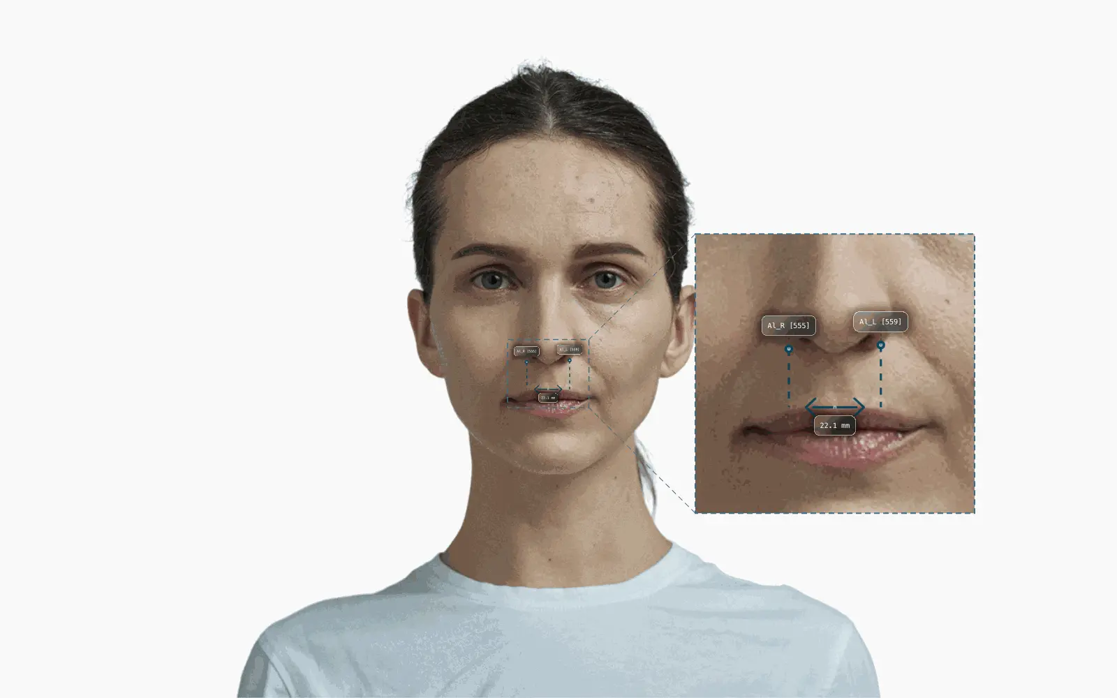 Alar width measured between Al landmarks on a female frontal portrait