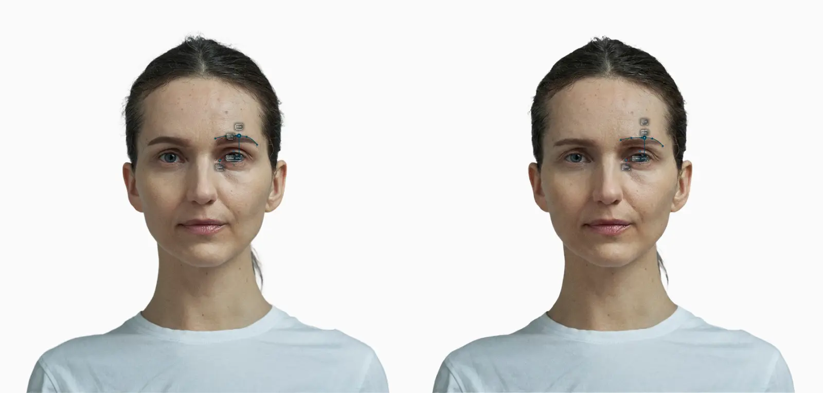 Brow elevation before and after on the same female face: brows lowered toward the eyes