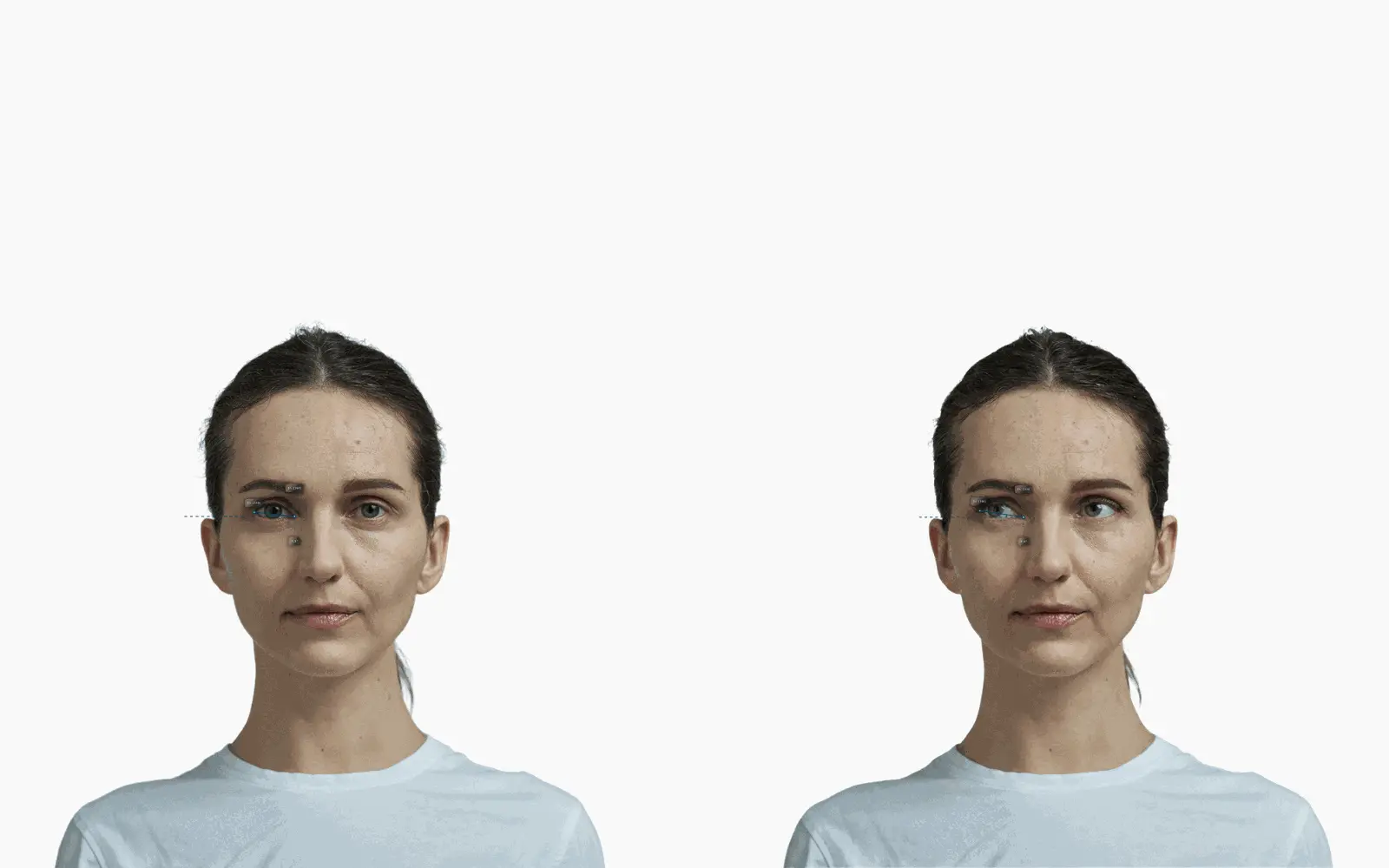 Female frontal portrait before and after lateral canthus elevation, with the canthal tilt drawn on each eye
