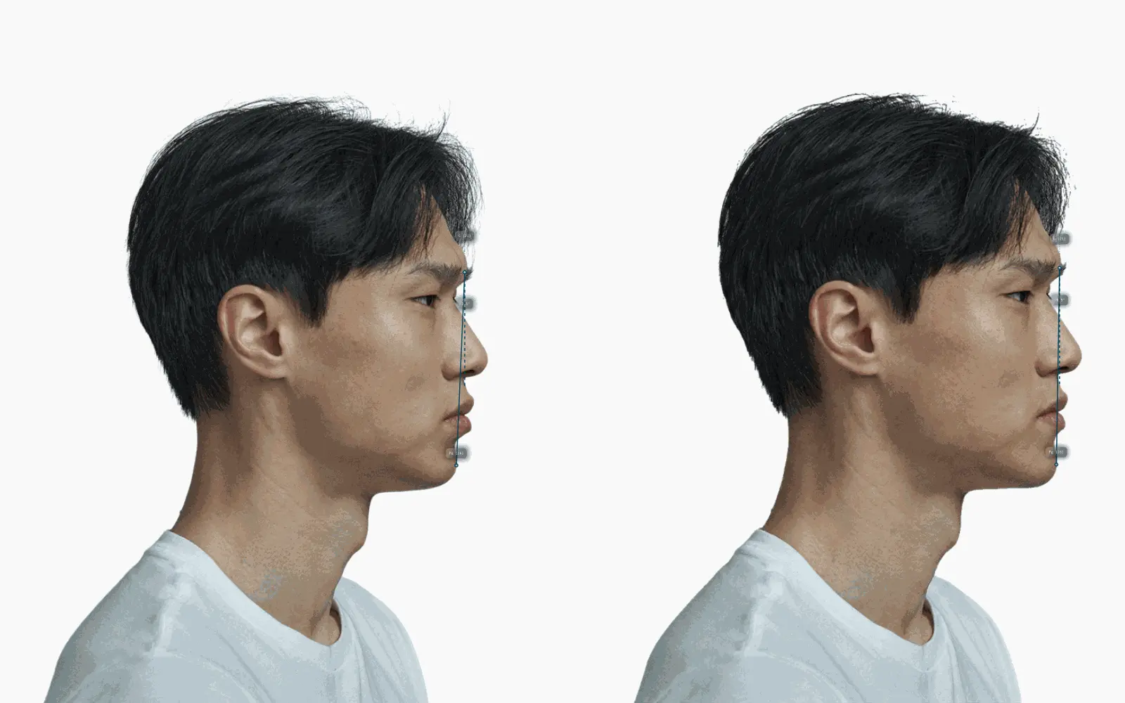 Male profile before and after a 4 mm pogonion advancement