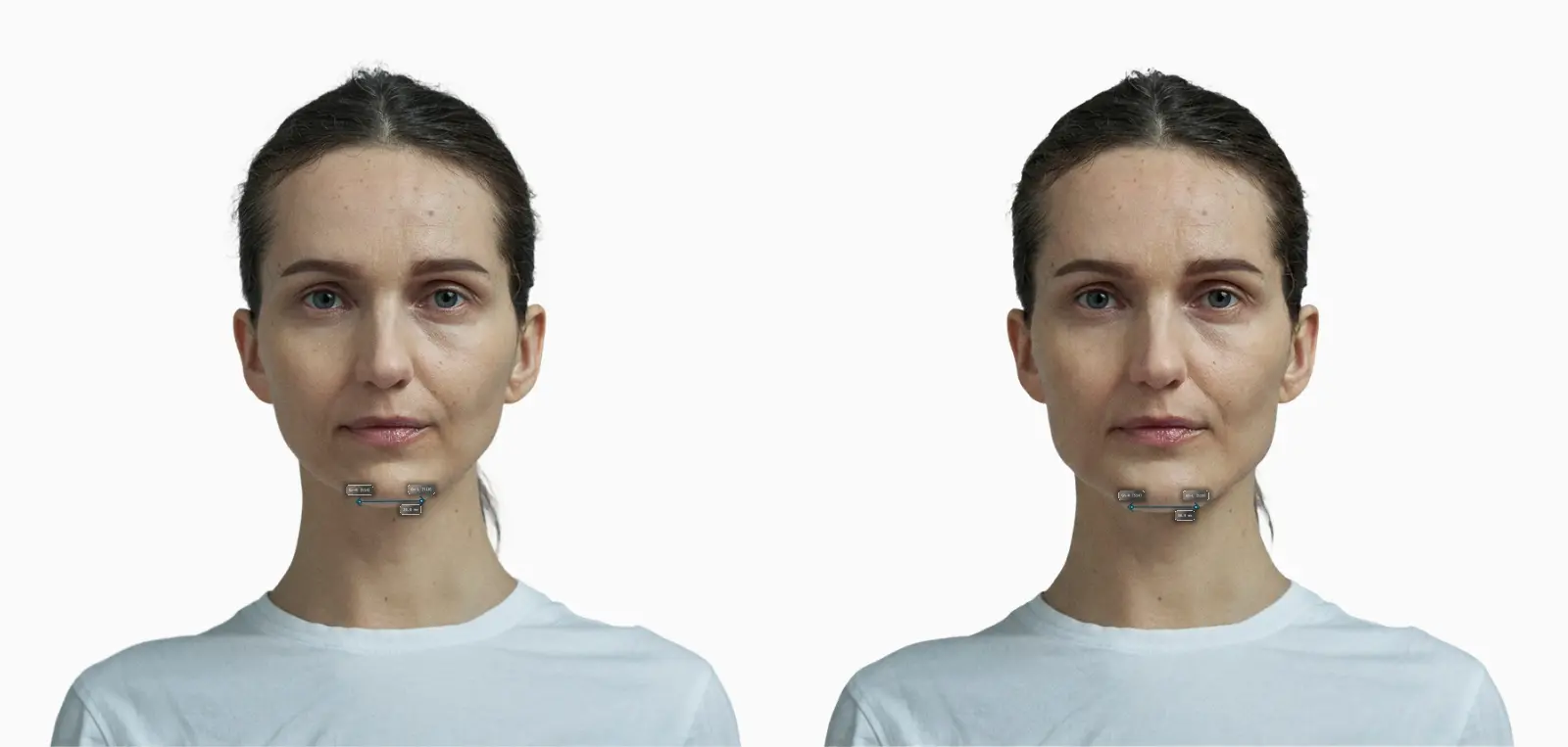 Chin width before and after widening the chin on the same female face, measured edge to edge on each