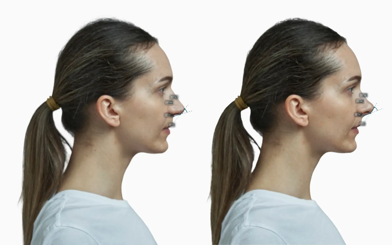The same female profile with a more upturned, sharper nasal tip on the right, the double break angle drawn at the columella on each