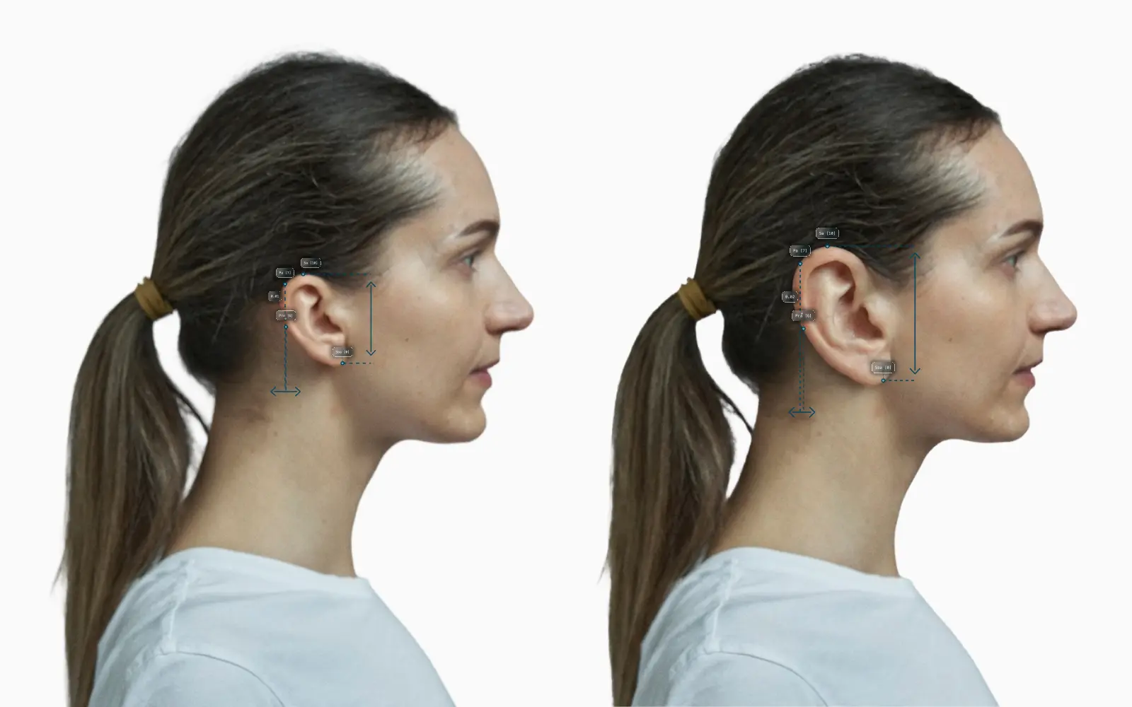 Ear size before-and-after comparison on a female face