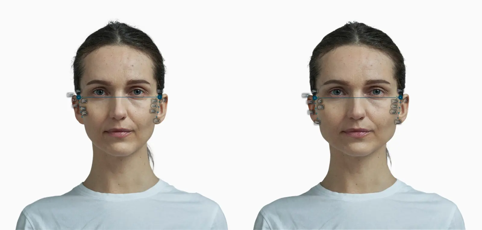 Facial width before-and-after comparison on a female face: a dramatically wider bizygomatic span