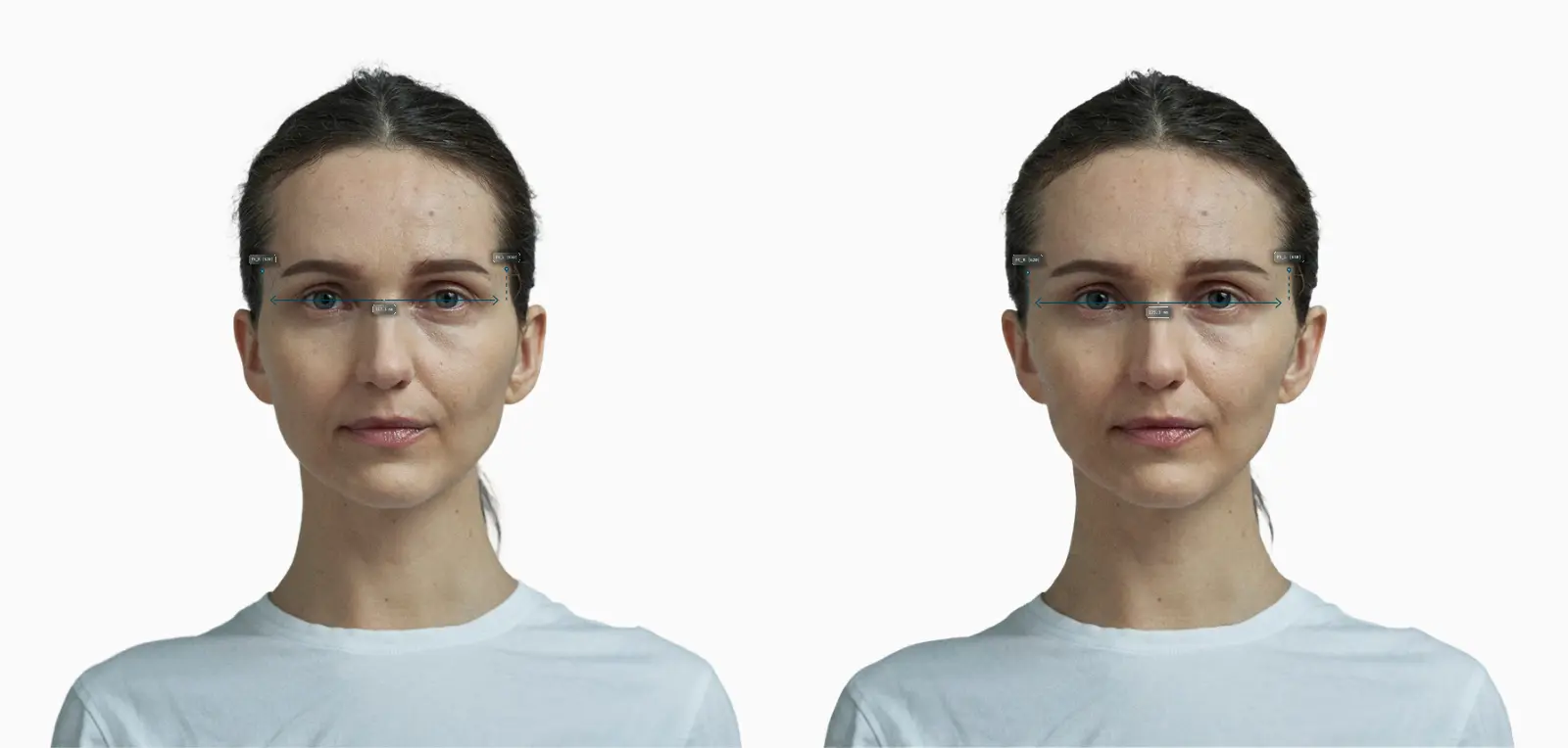 Forehead width before-and-after comparison on a female face