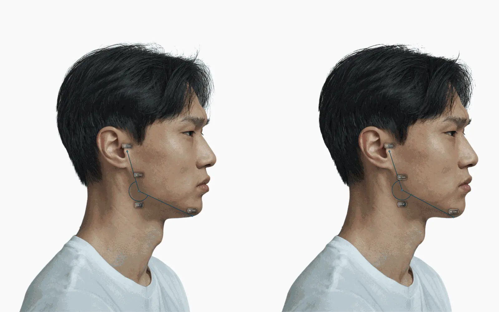 Male side profile before and after the mandibular corner is softened, with the gonial angle drawn on each face