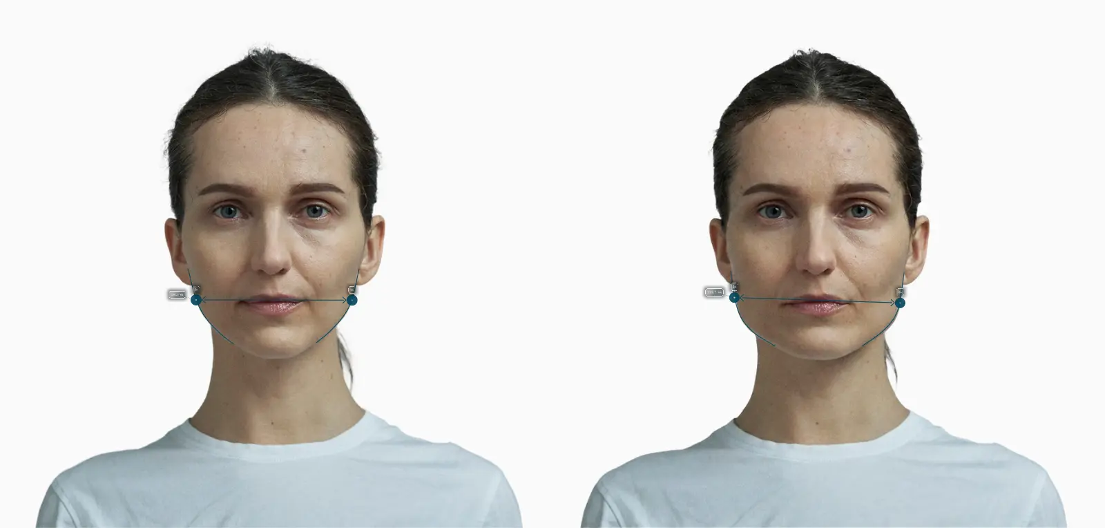 Jaw width before-and-after comparison on a female frontal face