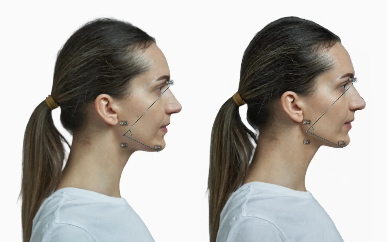 Lower gonial angle before-and-after comparison on a female face