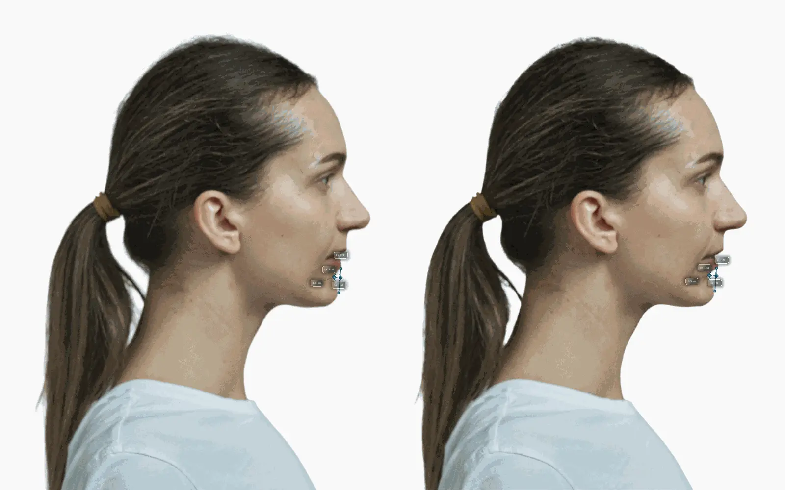 Female profile with labiomental sulcus deepened, sharper chin-lip groove