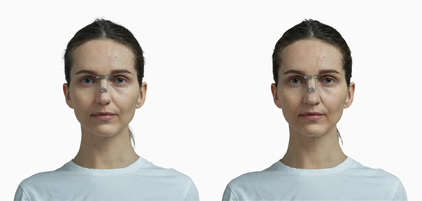 Nasal bridge width before-and-after comparison on a female frontal face: a broader upper nose widens the bridge