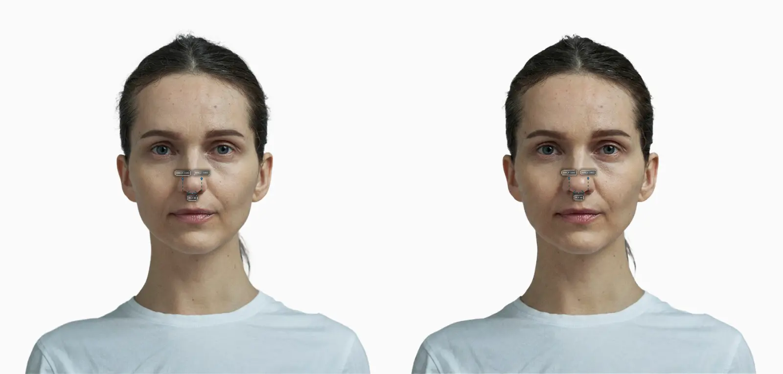 Nasal tip width before and after: the same female face with a wider, more bulbous tip