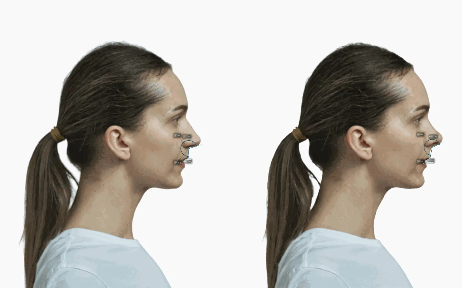 Female side profile before and after nose-tip rotation of about 15 degrees, with the nasolabial angle drawn on each