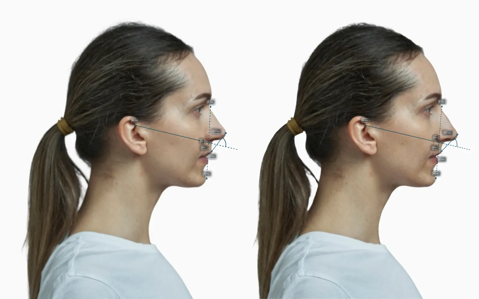 The same female profile with a more projected nose on the right, the nasomaxillary angle drawn from the midface on each