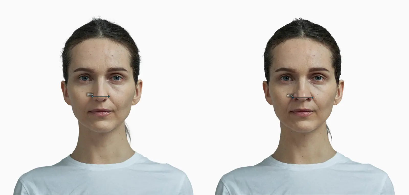 Nose width before-and-after comparison on a female face
