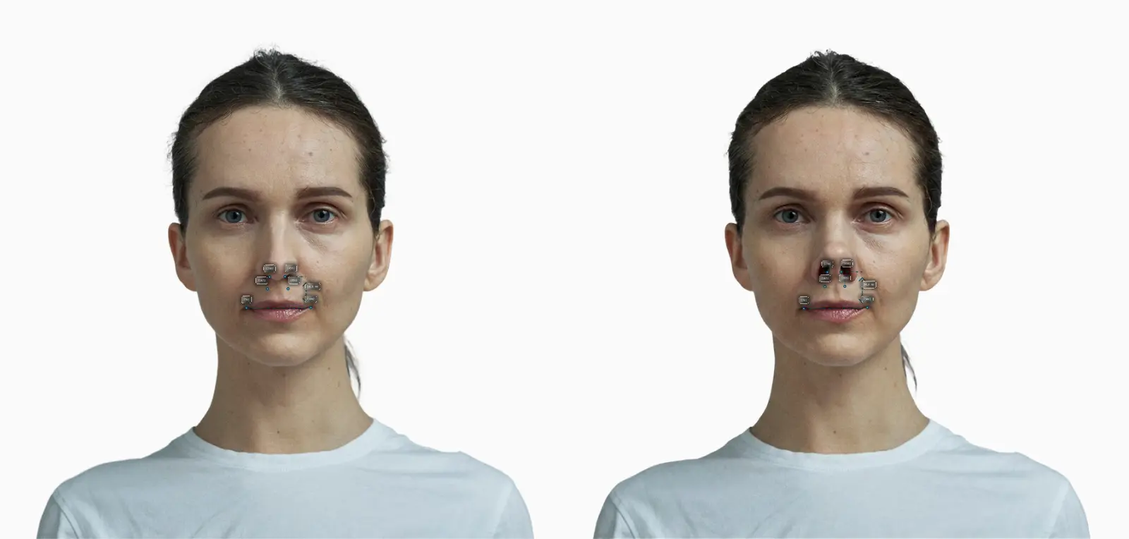 Nostril vertical span before-and-after comparison on a female frontal face: a shorter, upturned nose raises the nostril show
