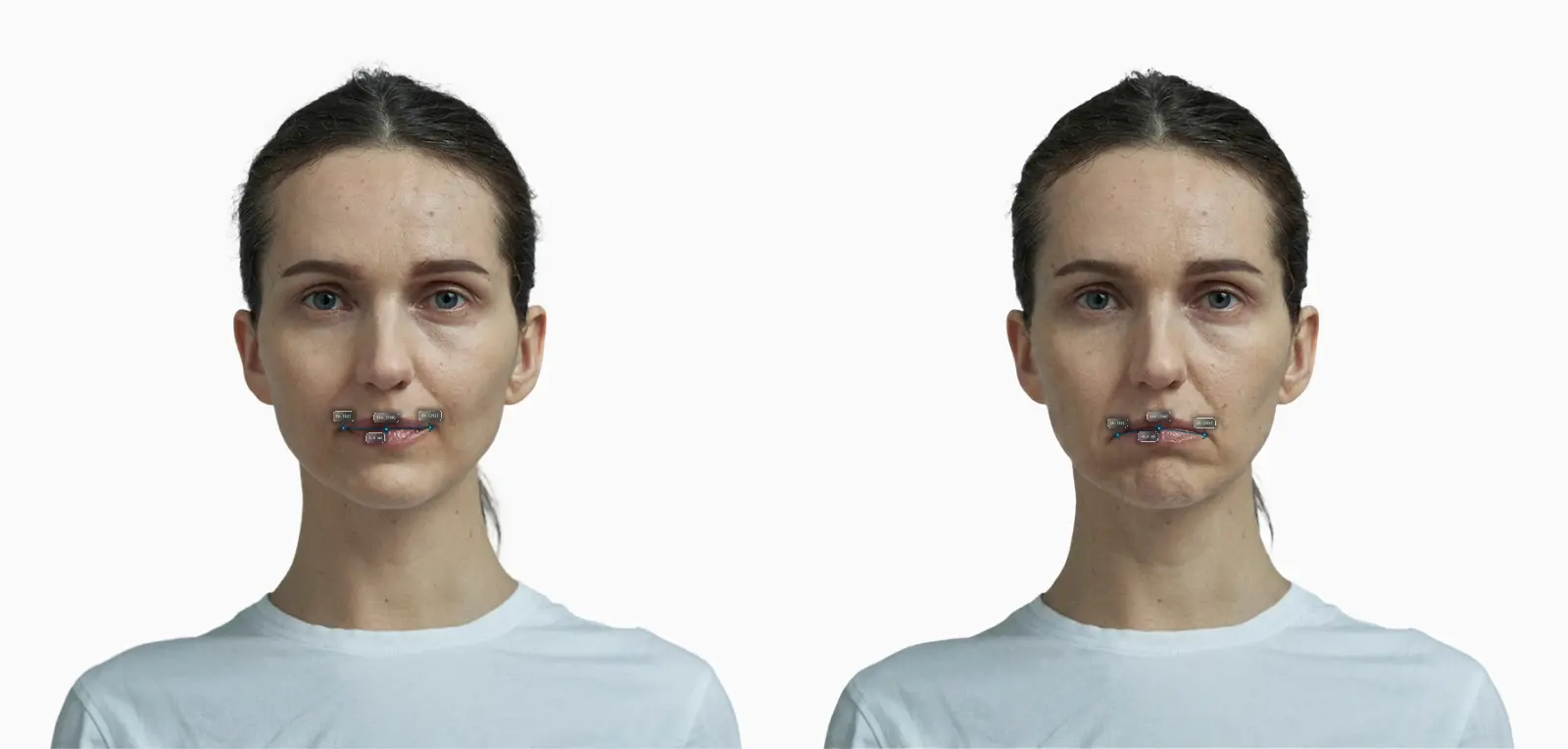 Oral commissure tilt before-and-after comparison on a female face