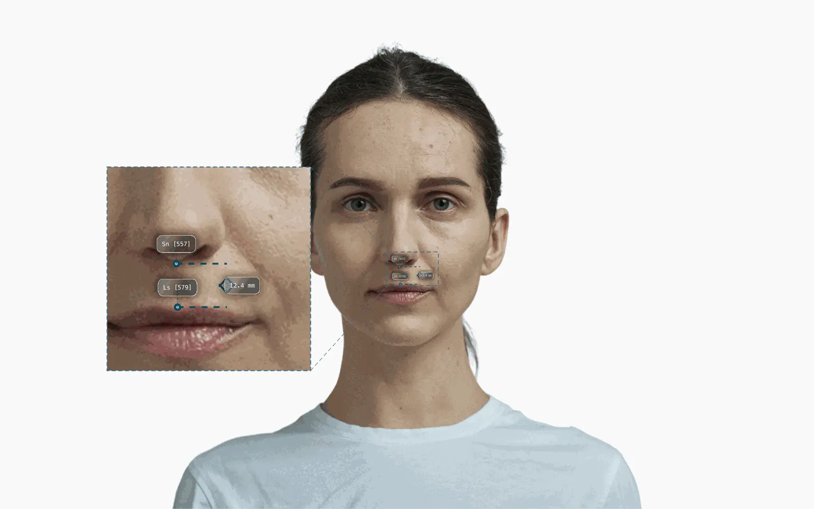 Philtrum length annotated on a female frontal portrait, Sn to Ls