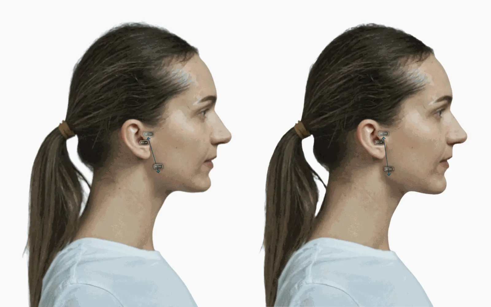 Female profile before and after a posterior mandibular ramus extension, length 39.9 to 50.8 mm