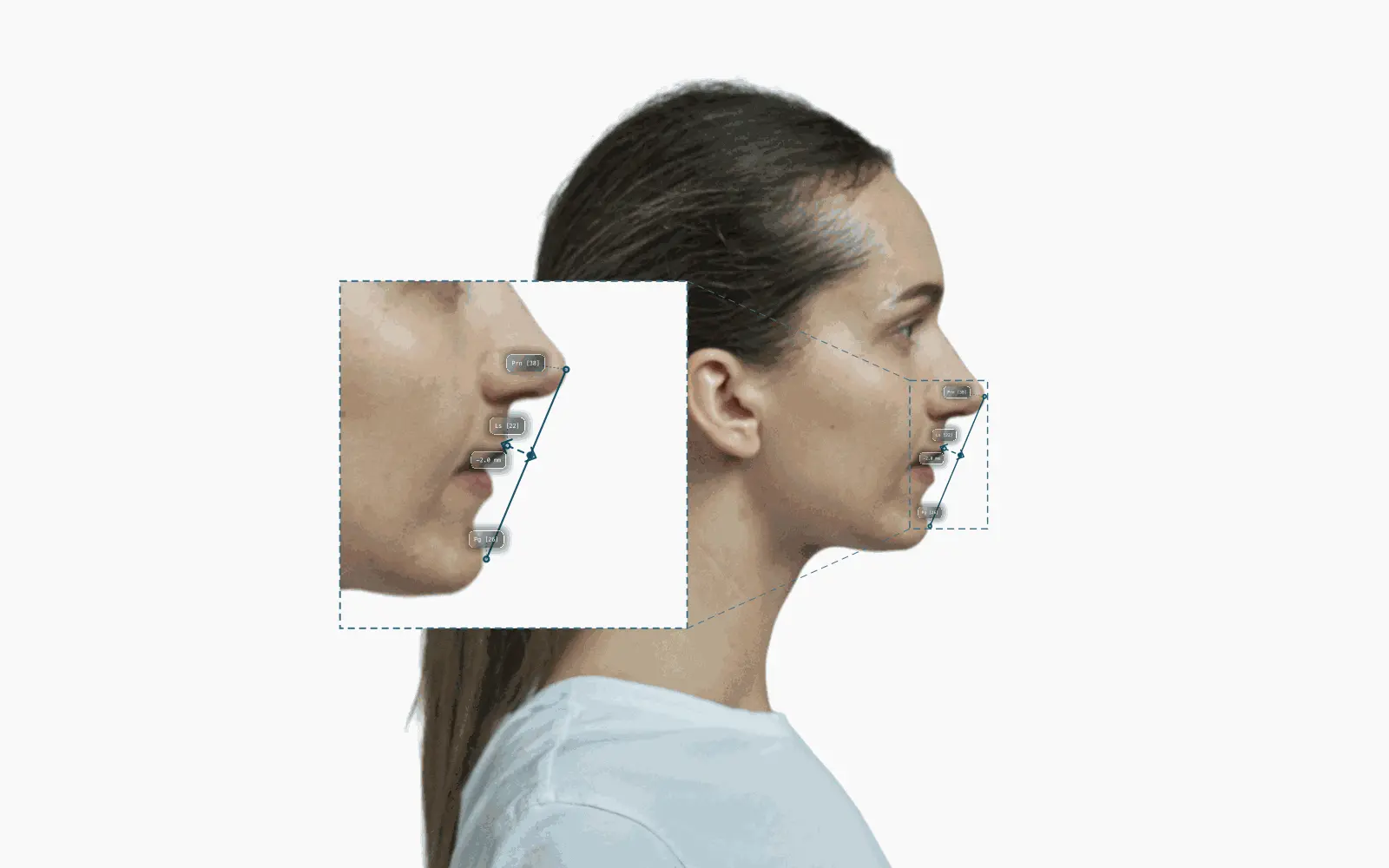Ricketts E-line on a female profile, upper lip 2 mm behind the line