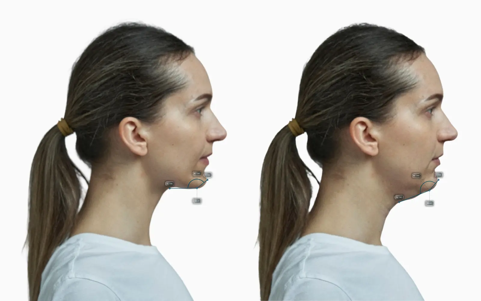 Submental angle before-and-after comparison on a female face