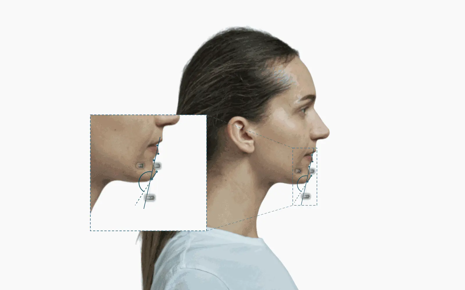 Submental-cervical angle annotated on a female right-profile portrait