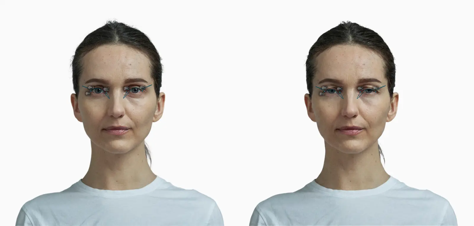 Upper eyelid curvature before-and-after on a female face: a flatter lid versus a more hooded lid