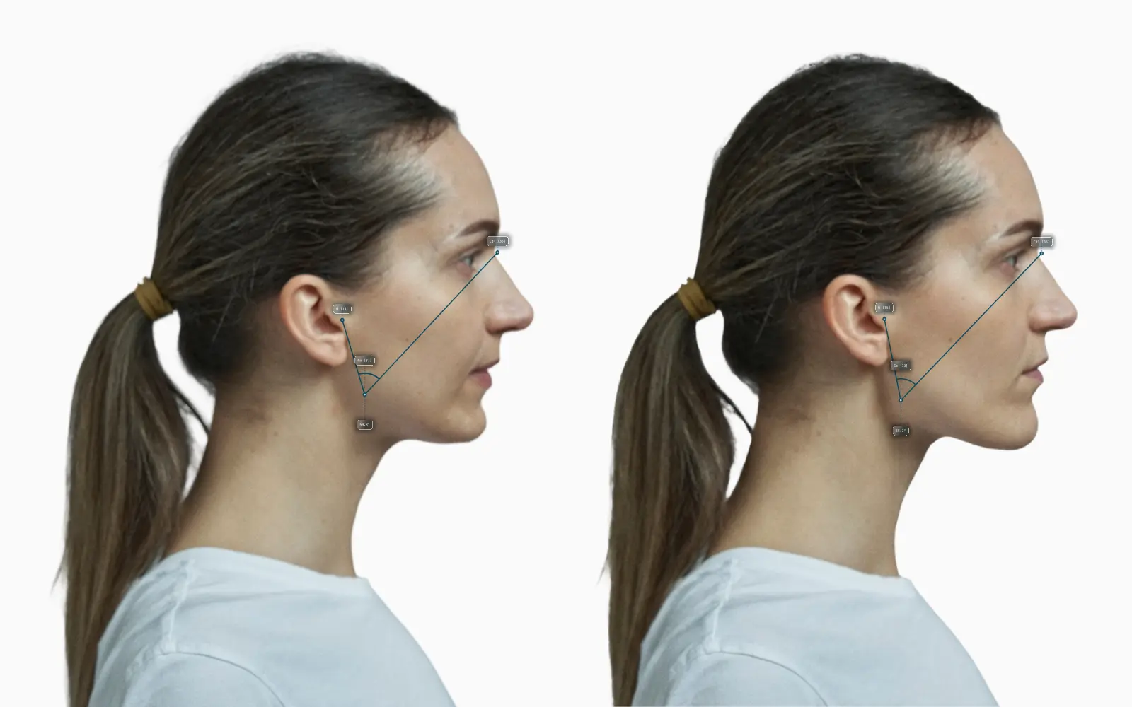 Upper gonial angle before-and-after comparison on a female face
