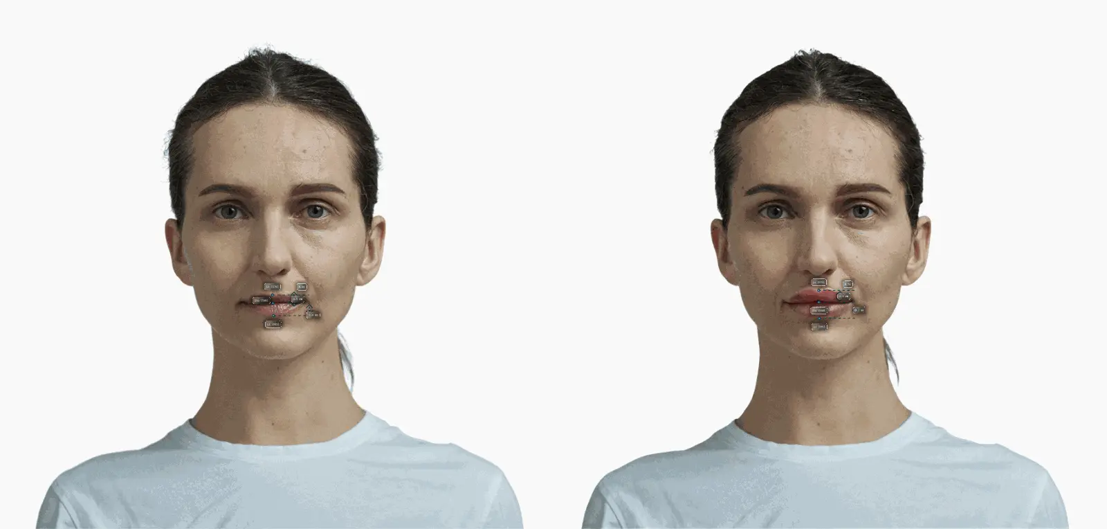 Female frontal portrait with lower-lip volume added, ratio 1:1.53 to 1:2.01