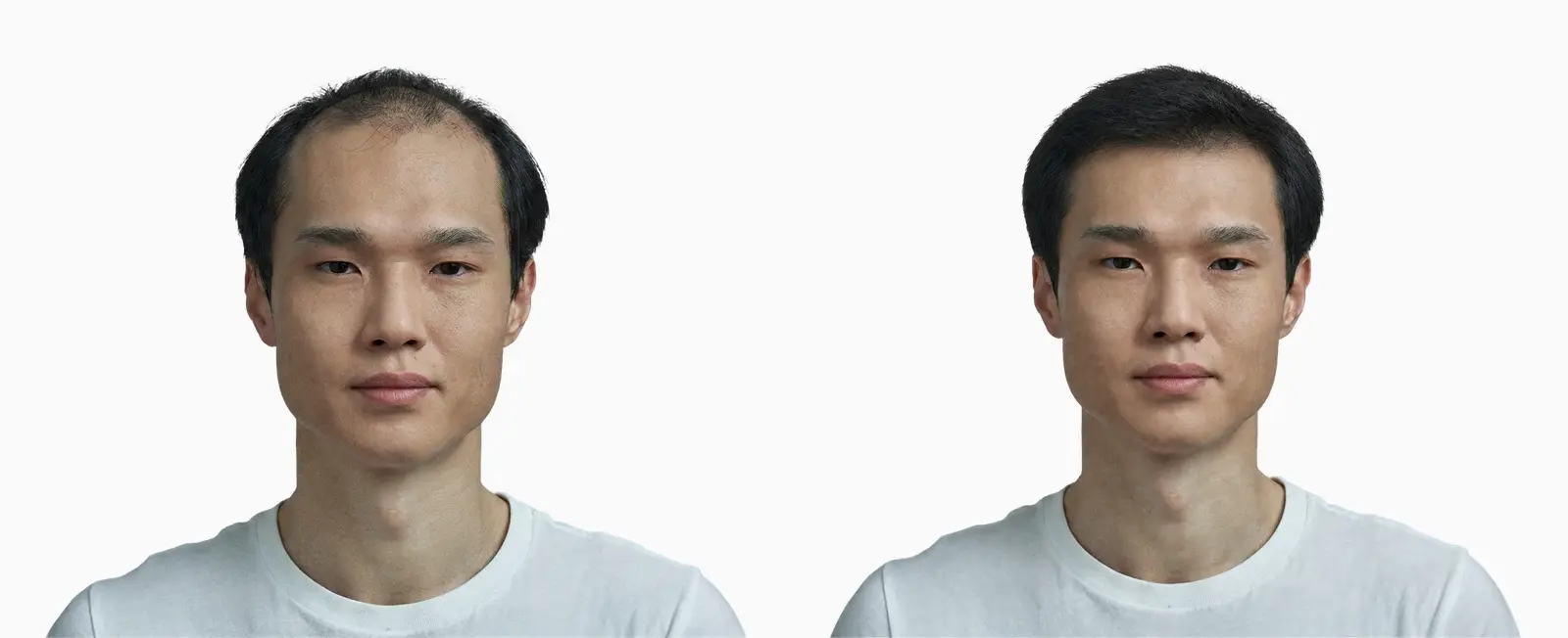Male pattern hair loss before and after 12 months of medical treatment