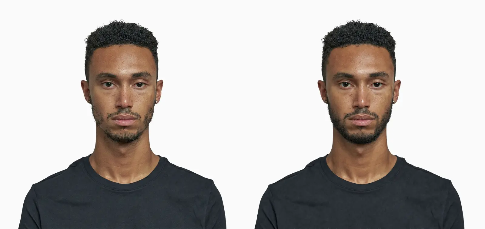 Patchy beard before and after 12 months of topical minoxidil application