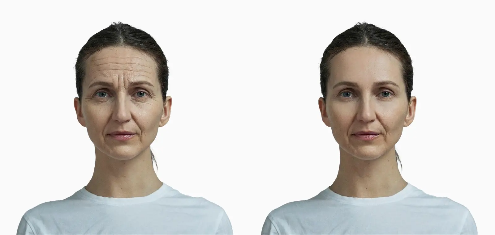 Forehead and frown lines before and after botulinum toxin injection on the same face