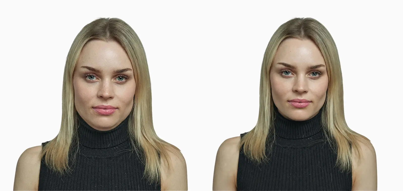 Submental fat reduction before and after CoolSculpting, with jawline definition restored