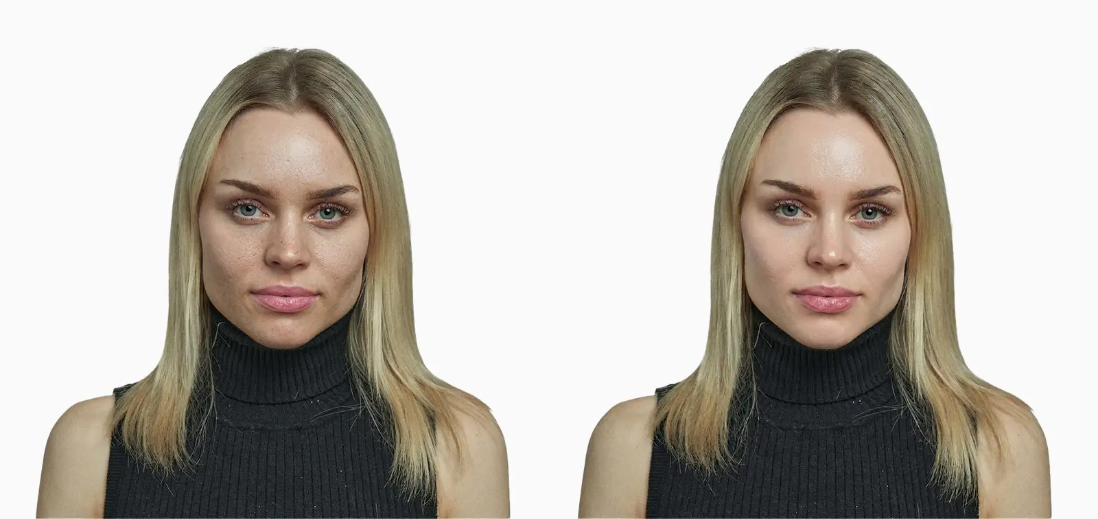 Dull skin texture before and after microdermabrasion exfoliation