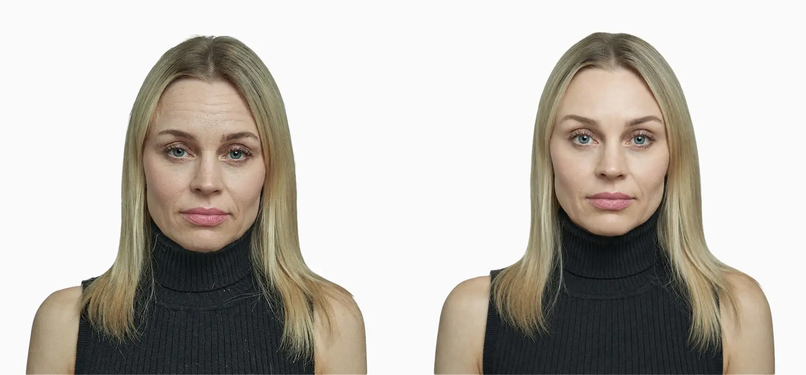 Heavy brow and forehead lines before and after endoscopic brow lift