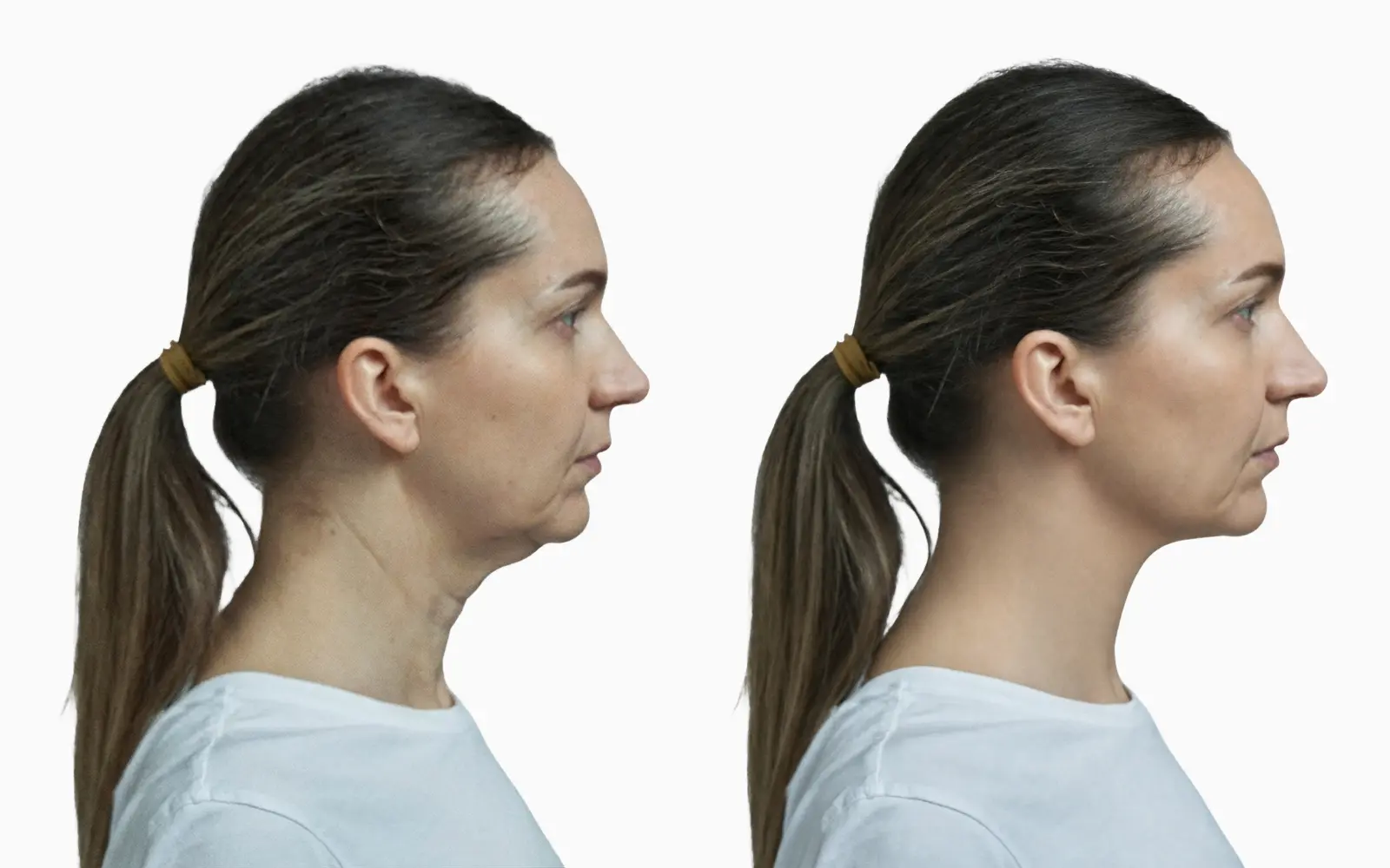 Submental fullness and obtuse cervicomental angle before and after neck lift in profile