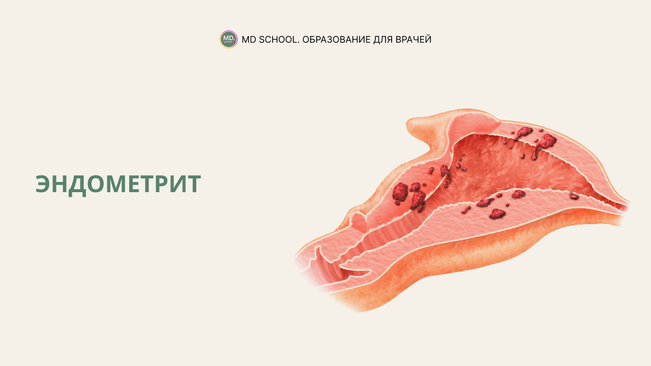 Картинка статьи Эндометрит