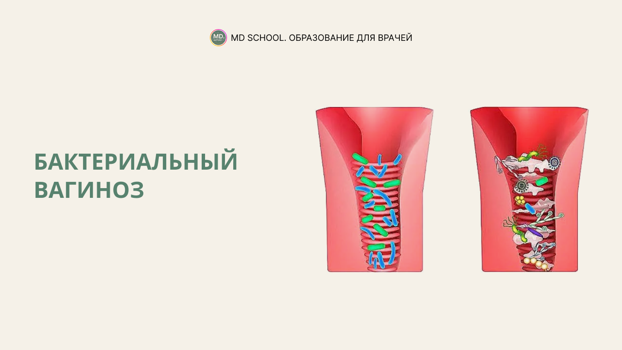 Картинка статьи Бактериальный вагиноз