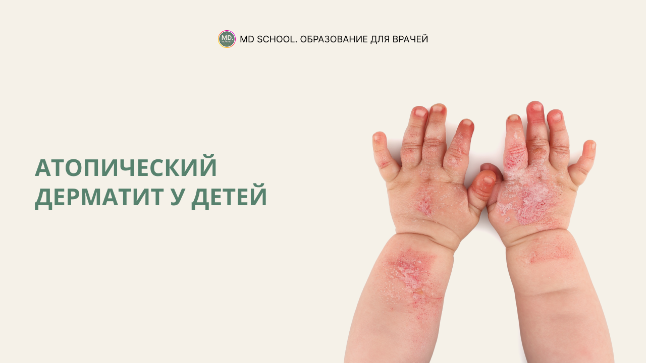 Картинка статьи Атопический дерматит у детей