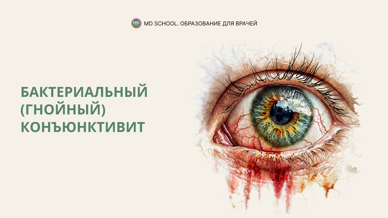 Картинка статьи Бактериальный (гнойный) конъюнктивит