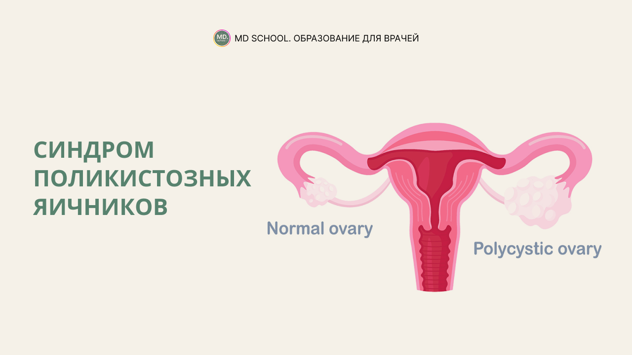 Картинка статьи Синдром поликистозных яичников