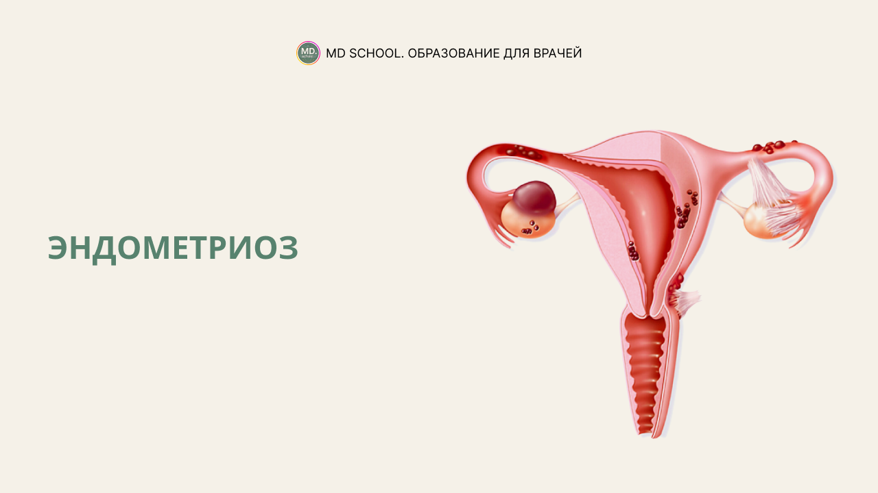 Картинка статьи Эндометриоз