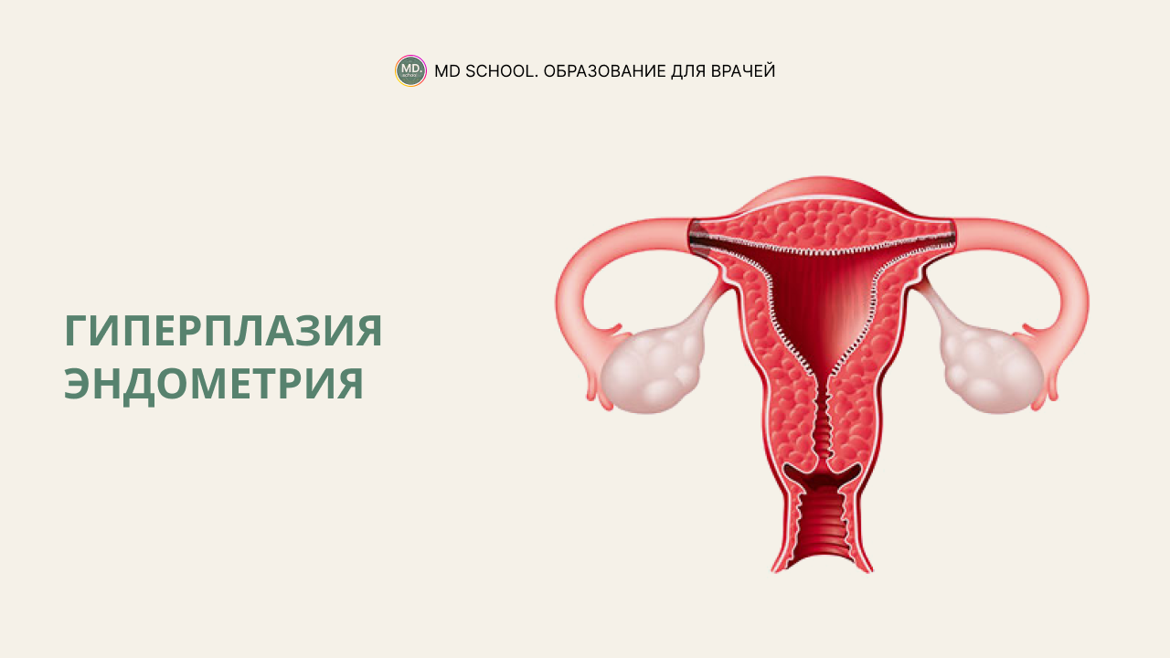 Картинка статьи Гиперплазия эндометрия