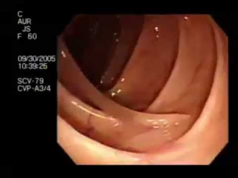 askaridy v kishkah.jpg