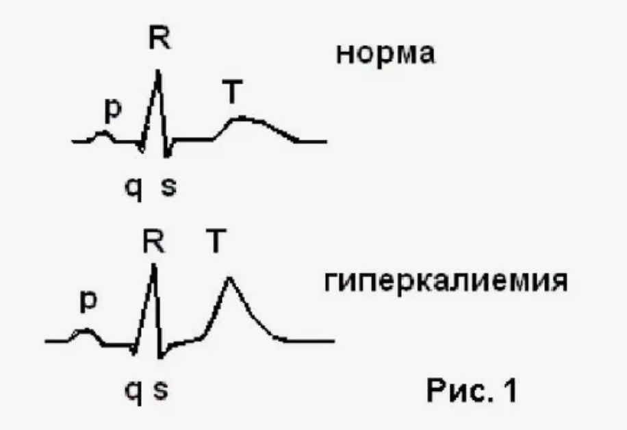 Гиперкалиемия