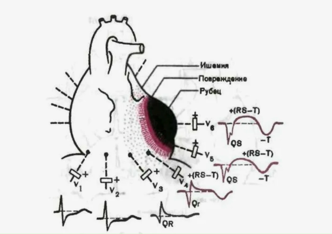 Аневризма ЛЖ