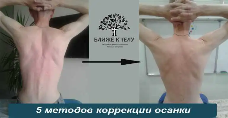 Сколиоз можно исправить