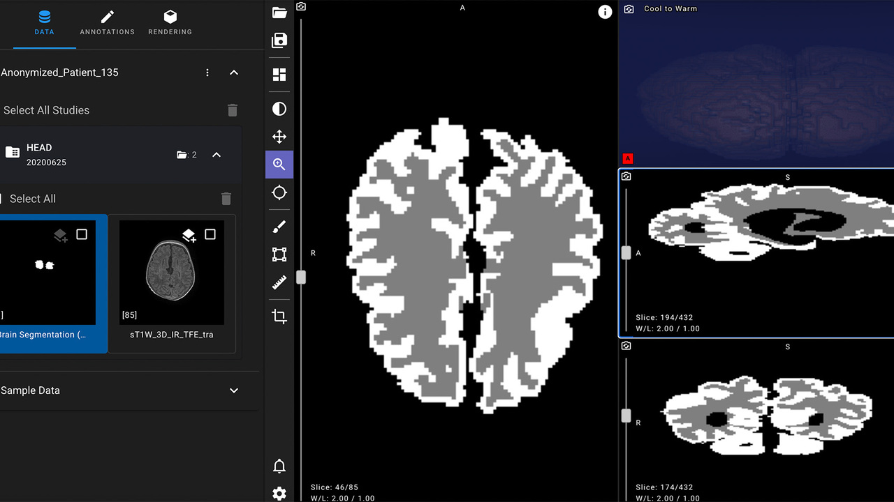ИИ Яндекса ускорит диагностику ДЦП у новорожденных
