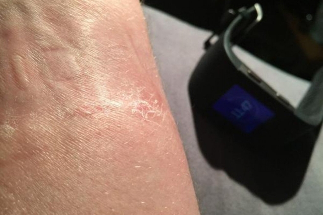 Фитнес-трекер Fitbit Surge травмирует руки пользователей (фото)