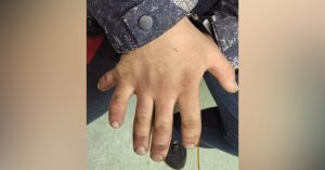 Напавшего на прохожую в Зеленограде нашли благодаря тому, что у него по шесть пальцев на руках