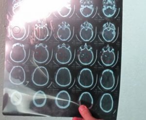 Рентгеновский снимок головы того же солдата с осколками взрывного устройства в черепе, полученные при "общении" с "мирными демонстрантами"